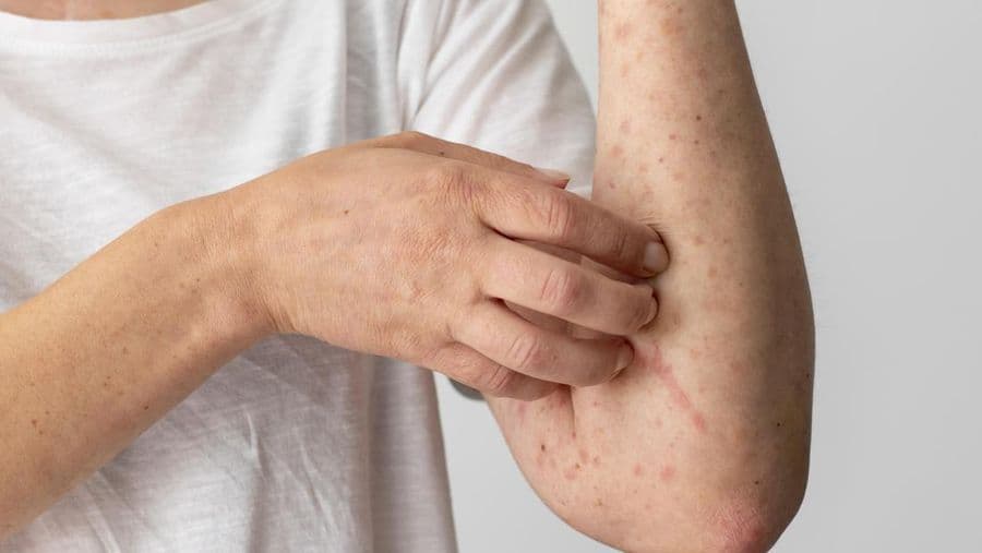 Dokter Muda di Cianjur Meninggal akibat Campak, Kemenkes Lakukan Penyelidikan Epidemiologi